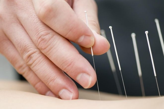 The Benefits of Acupuncture That Everyone Should Know from North Carolina Lifestyle Blogger Champagne Style Bare Budget